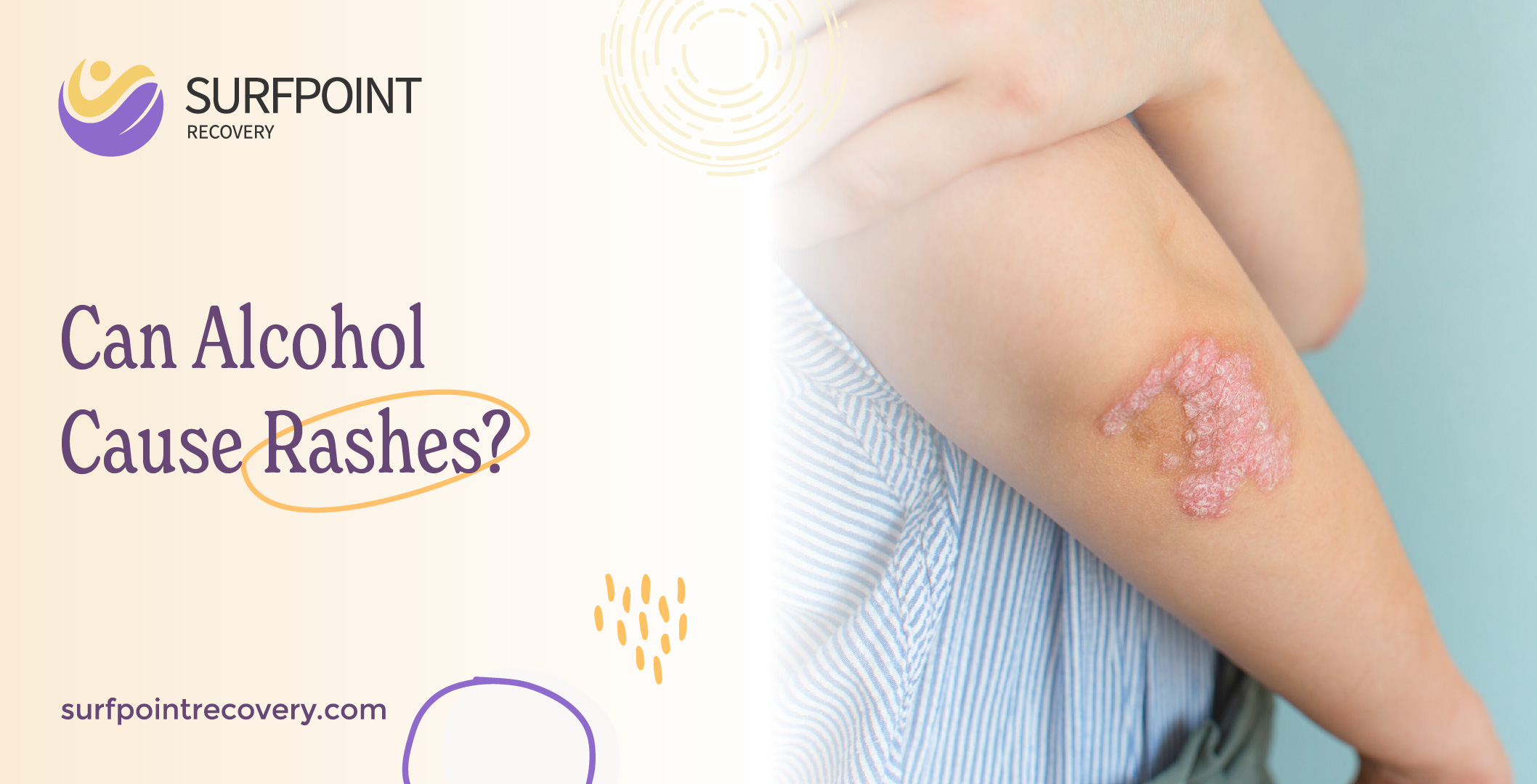 Can Alcohol Cause Rashes?